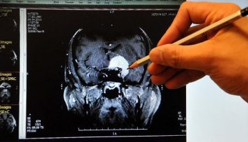 Her ‘unutuyorum’ diyen kişi Alzheimer hastası mı?