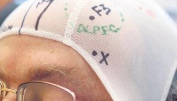 Depresyona karşı beyin implantı