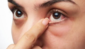 Göz alerjisi nedir? Göz alerjisinin belirtileri nelerdir?