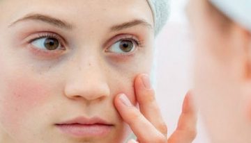 Lupus (SLE) hastalığı nedir? Lupus (SLE) hastalığı belirtileri nelerdir?