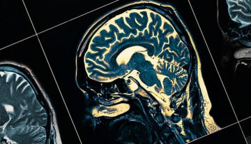 Parkinson hastalığında glutatyon tedavisi