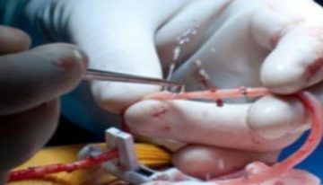 Hayat kurtaran yapay damar devrimi! Dünyada ilk oldu… Türk doktor başardı